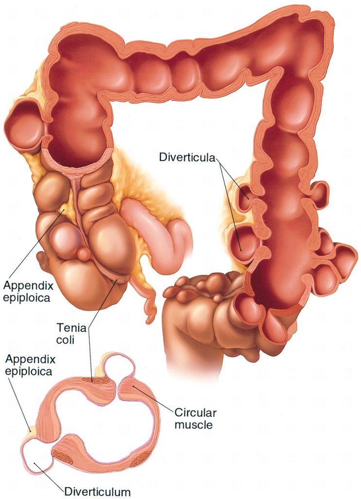 tirzepatide and diverticulitis Diverticulitis Surgery Melbourne